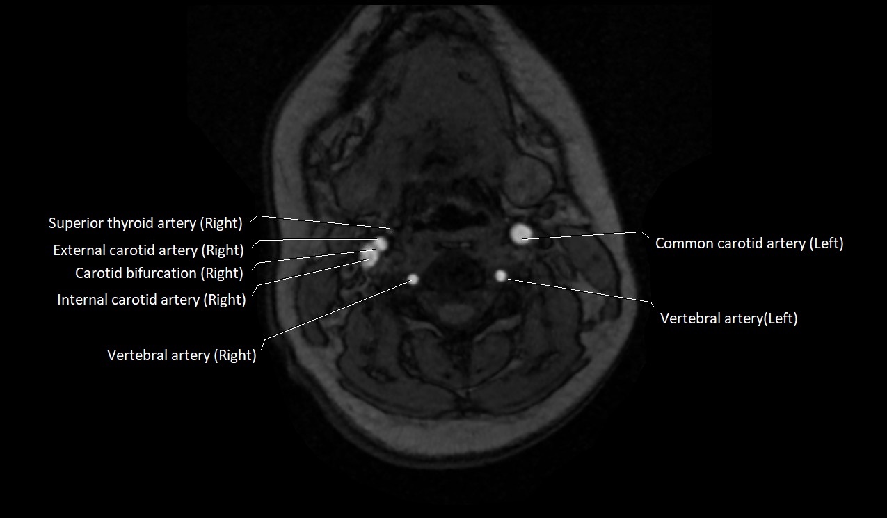 Carotid artery anatomy axial 3T image 29.jpg